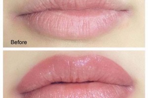 before-after-lips-05-18